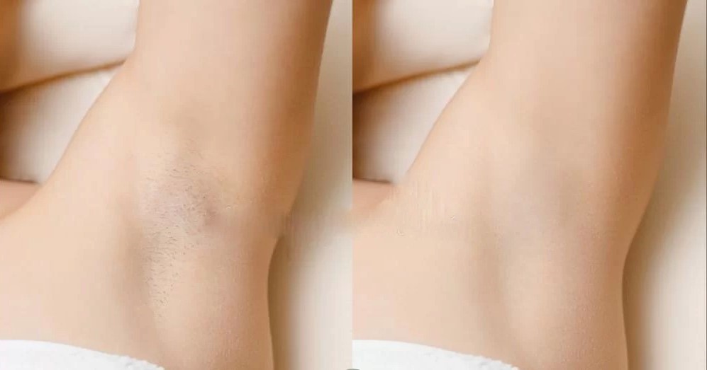underarm laser hair removal before and after